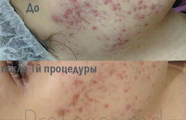 Laser cosmetology result — ProLaser Moldova