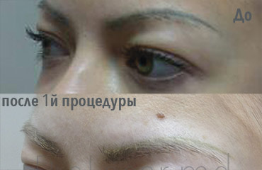 Laser cosmetology result — ProLaser Moldova