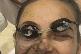 Laser carbon peel
