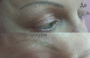 Lucrare ProLaser Moldova